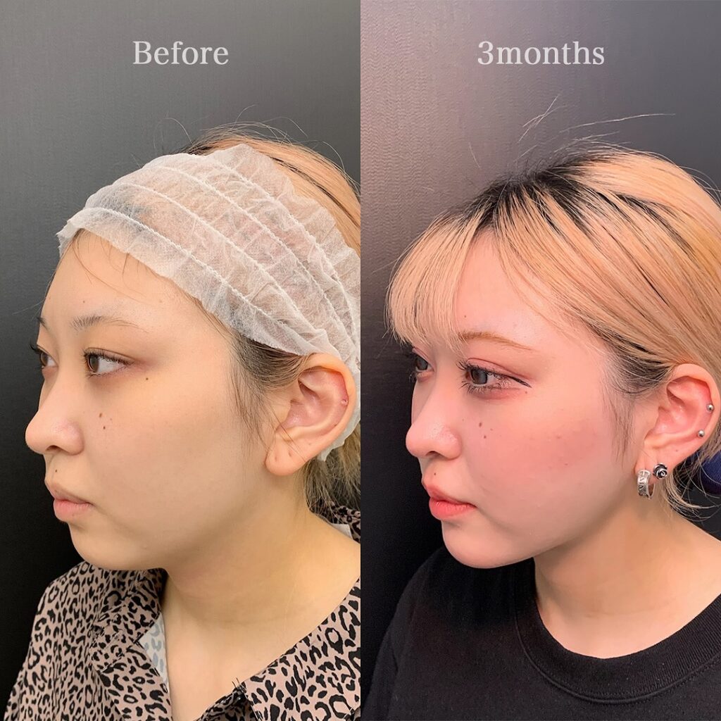 頬と顎下の脂肪吸引とジョールファットとメーラーファットと糸リフトと顎のヒアルロン酸注入の症例写真 (2)