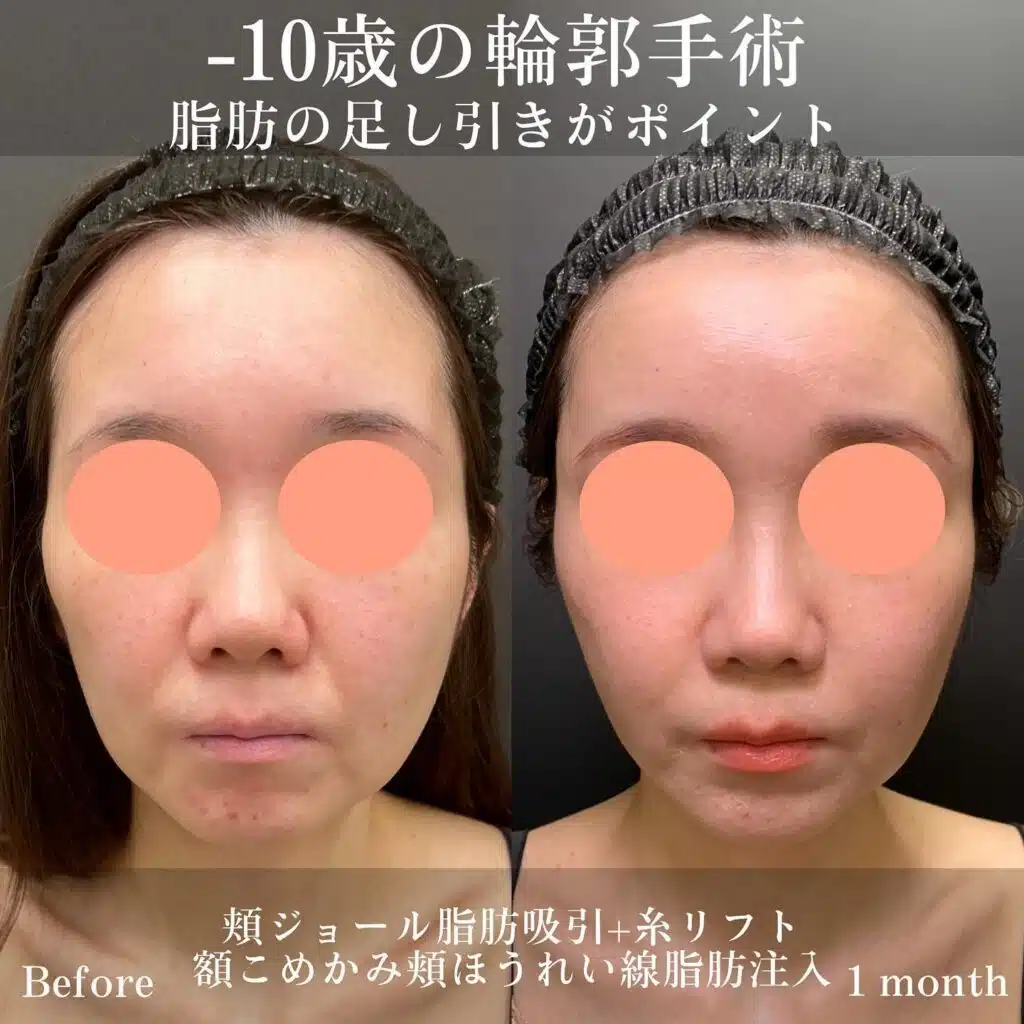 頬ジョール脂肪吸引+糸リフト　額こめかみ頬ほうれい線脂肪注入　横浜みなとみらい