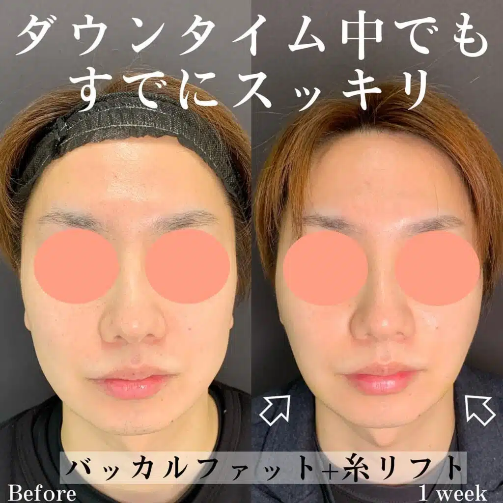 バッカルファット+糸リフト 横浜みなとみらい