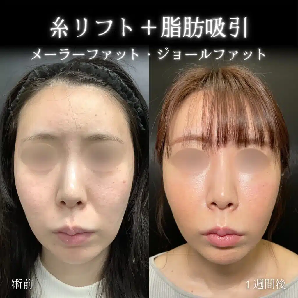 糸リフト+脂肪吸引 横浜みなとみらい