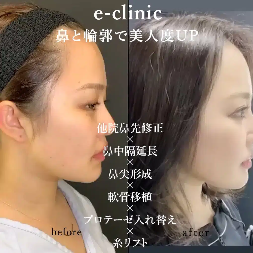 他院鼻先修正×鼻中隔延長×鼻尖形成×軟骨移植×プロテーゼ入れ替え×糸リフト 横浜みなとみらい