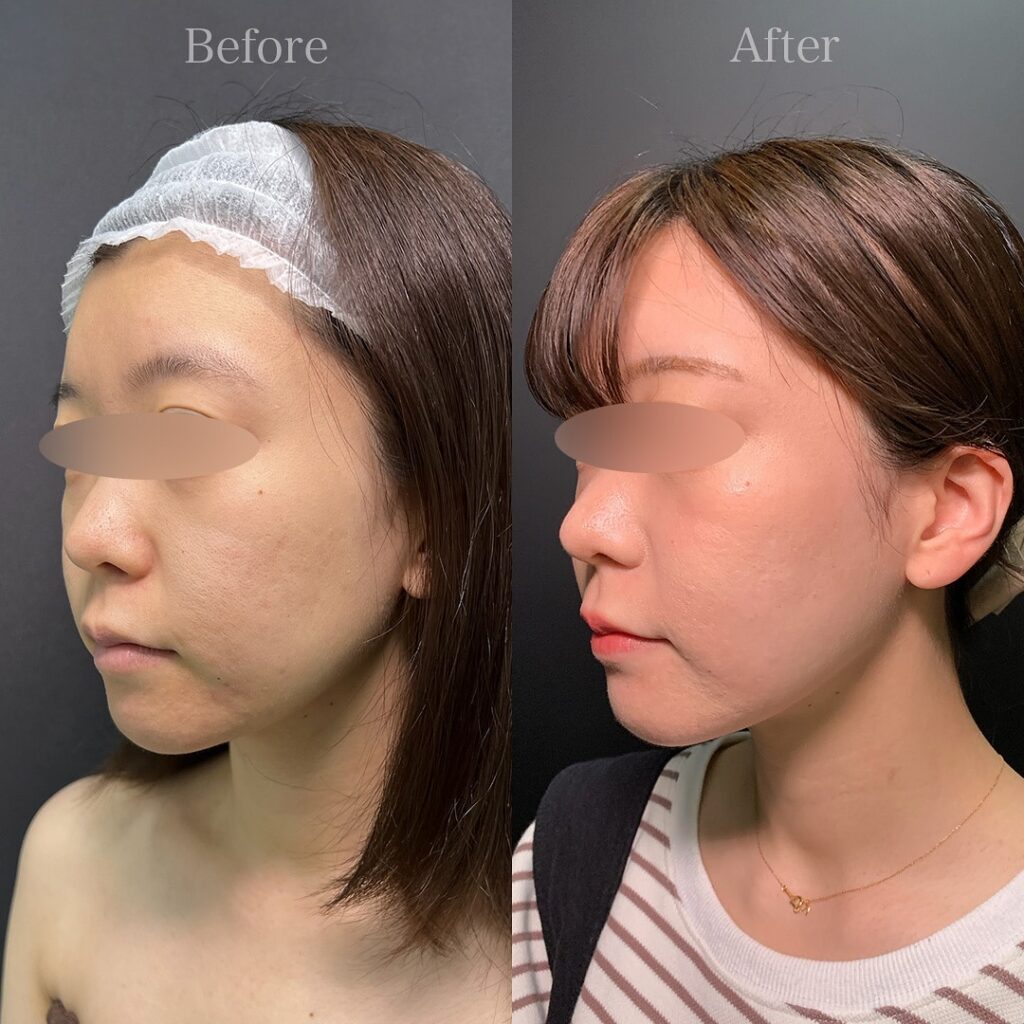 小顔の脂肪吸引と糸リフトの症例写真 (1)