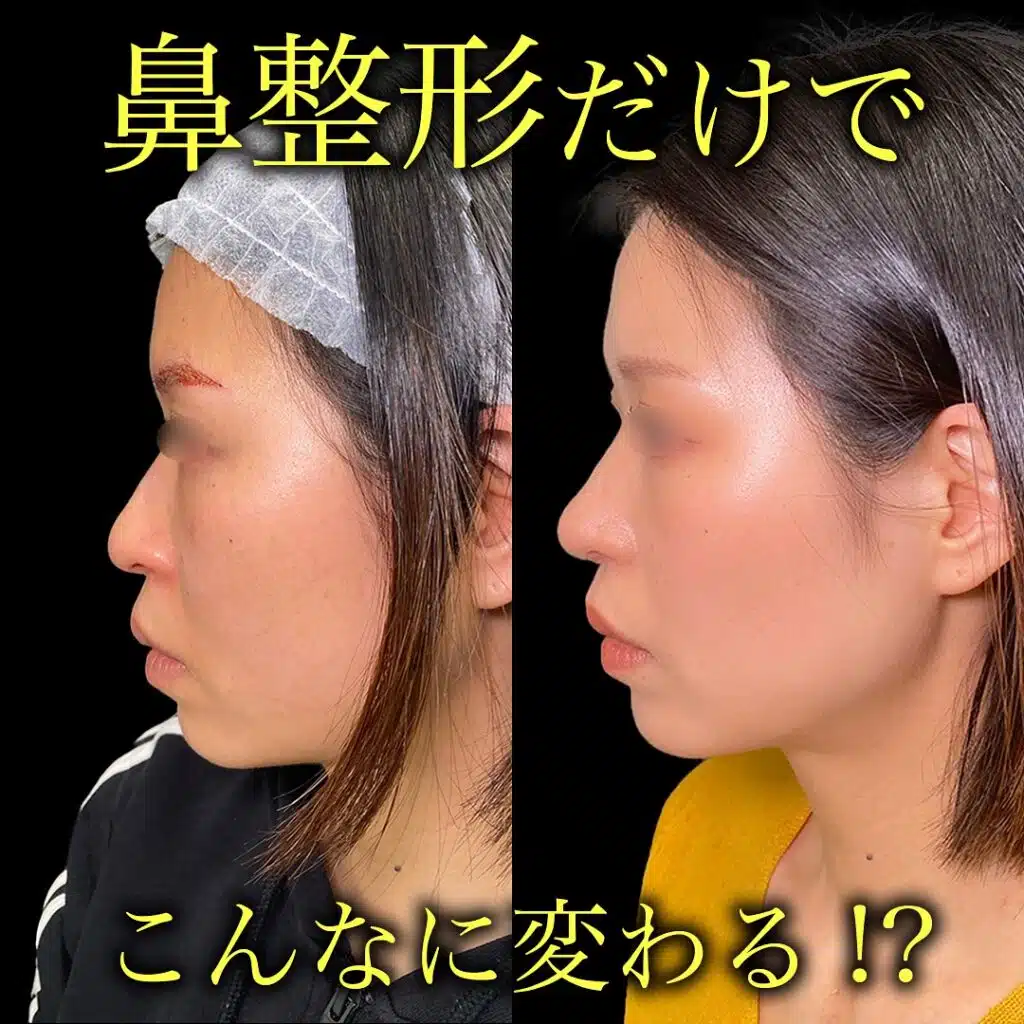 鼻尖形成と耳介軟骨移植と小鼻縮小 横浜みなとみらい