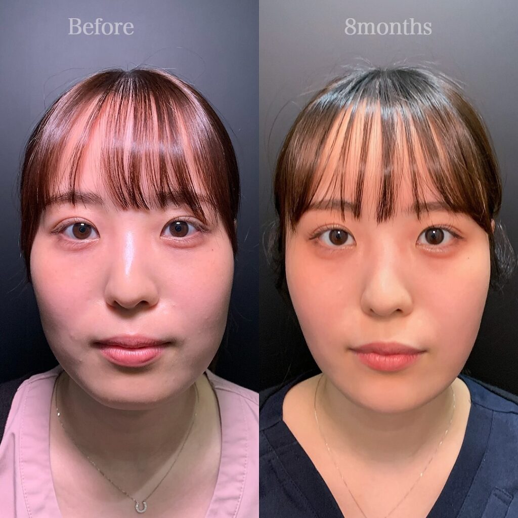 小顔脂肪吸引と糸リフトと脂肪注入の症例写真 (1)