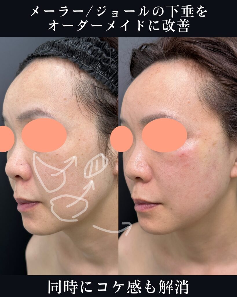 メーラーファットとジョールファットと糸リフトの症例写真