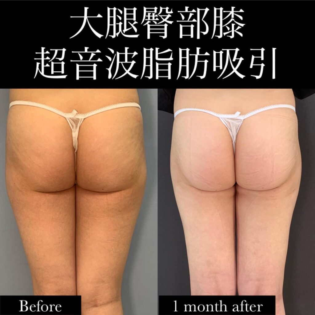 太ももの脂肪吸引の症例写真 (28)