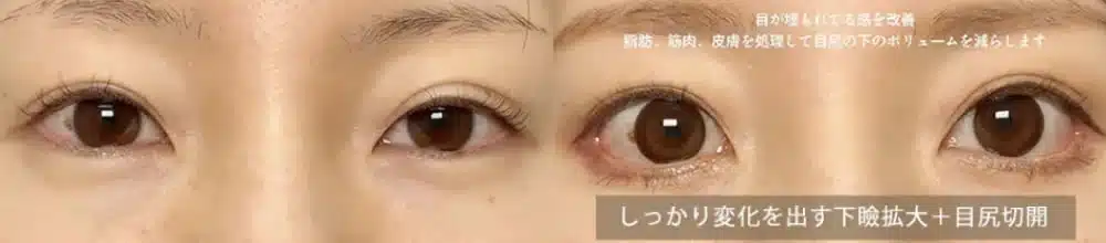 しっかり変化を出す下瞼拡大+目尻切開 横浜みなとみらい
