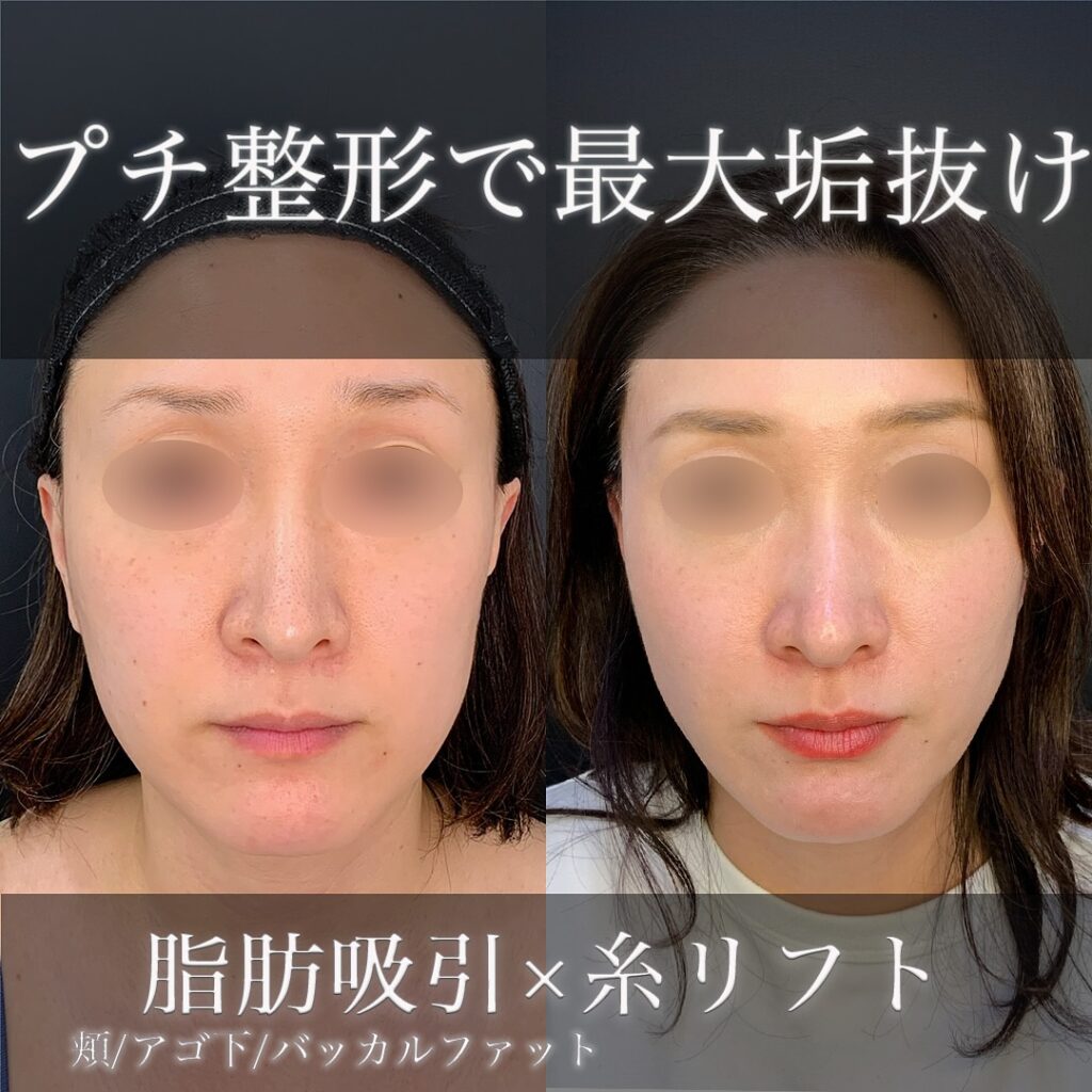バッカルファットと頬、顎下の脂肪吸引とこめかみの脂肪注入と糸リフトの症例写真 (1)
