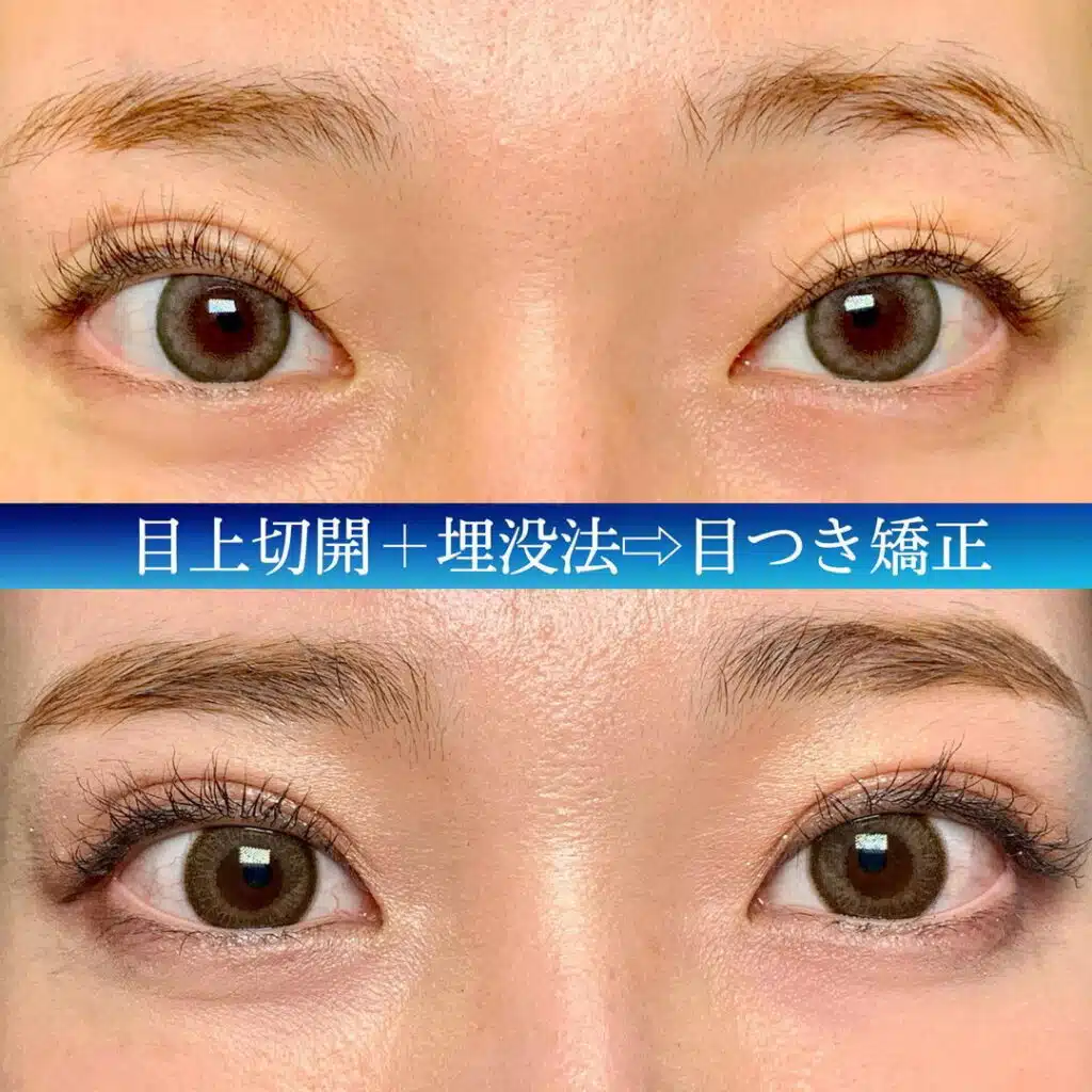 目上切開+埋没法　横浜みなとみらい