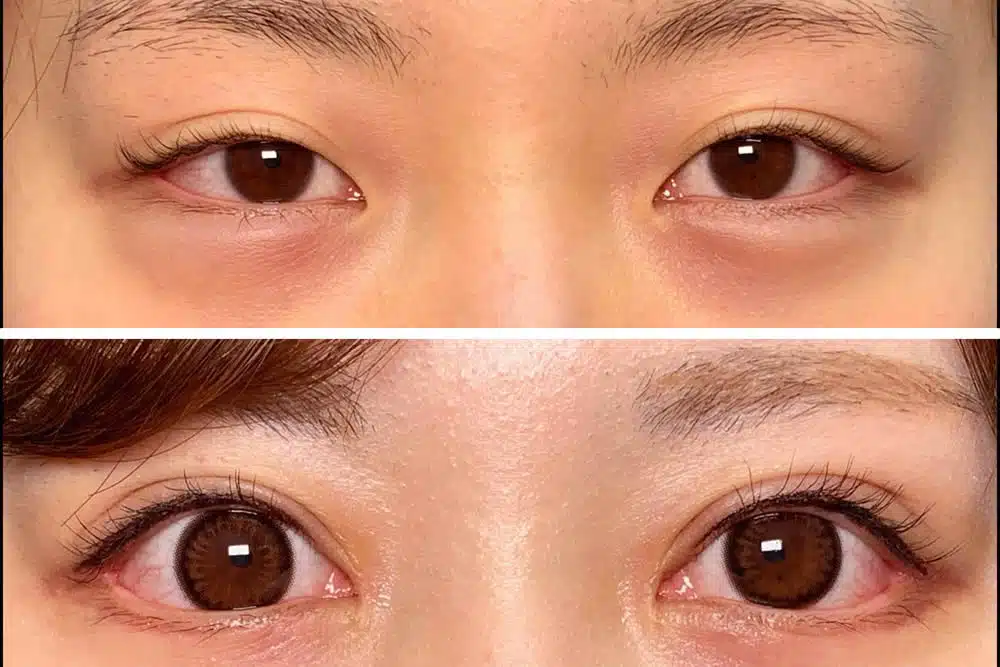 目尻切開+目頭切開 横浜みなとみらい