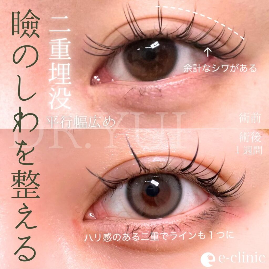 埋没法の症例写真 (10)