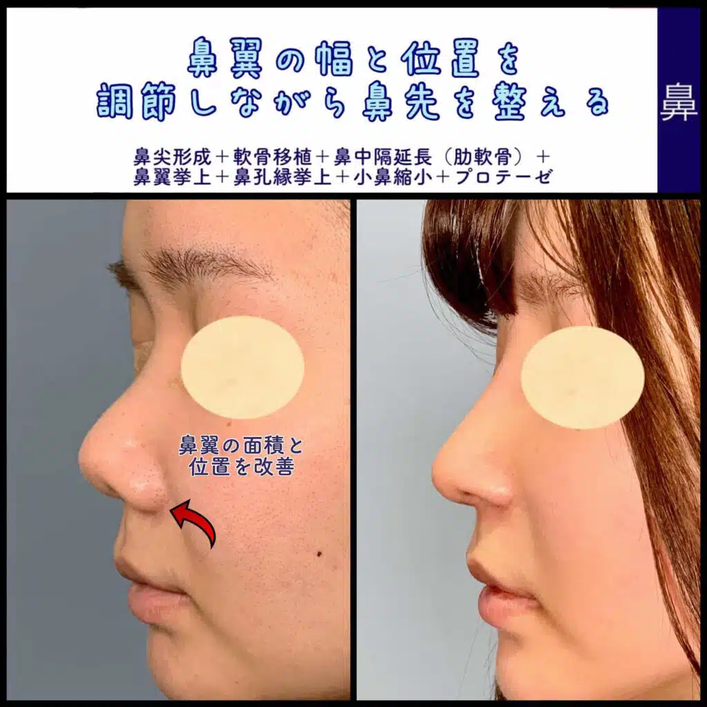 鼻尖形成+軟骨移植+鼻中隔延長(肋軟骨)+鼻翼挙上+鼻孔縁挙上+小鼻縮小+プロテーゼ 横浜みなとみらい