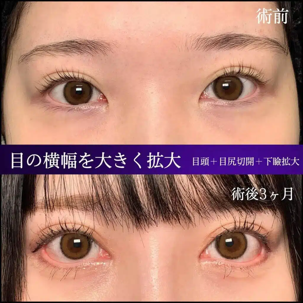 目頭+目尻切開+下瞼拡大 横浜みなとみらい