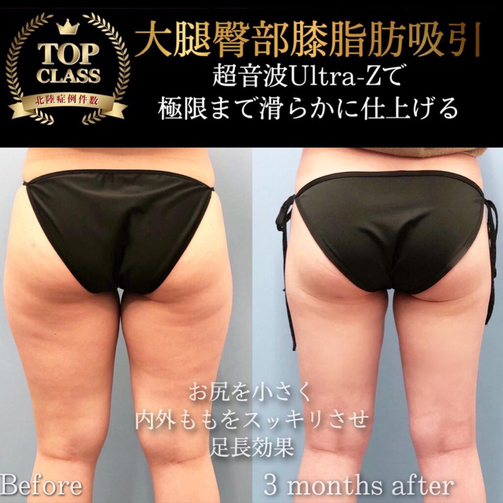 太ももの脂肪吸引の症例写真 (34)