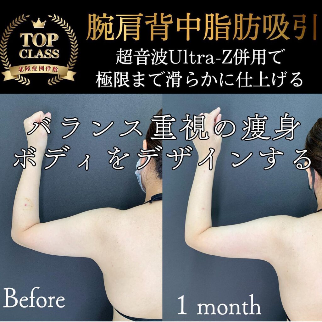 二の腕の脂肪吸引の症例写真 (8)