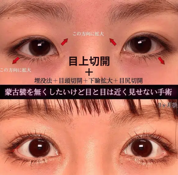 目上切開+埋没法+目頭切開+下瞼拡大+目尻切開　横浜みなとみらい