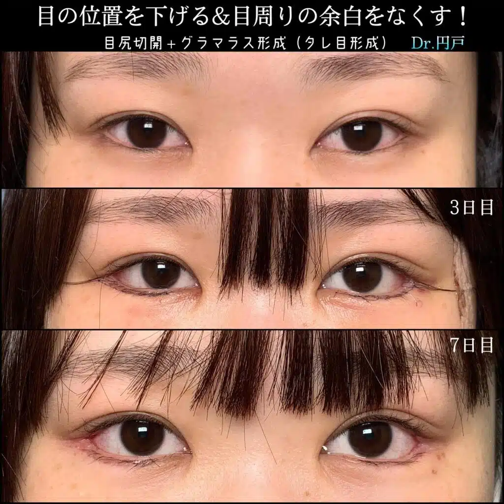 目尻切開+グラマラス形成(タレ目形成) 横浜みなとみらい