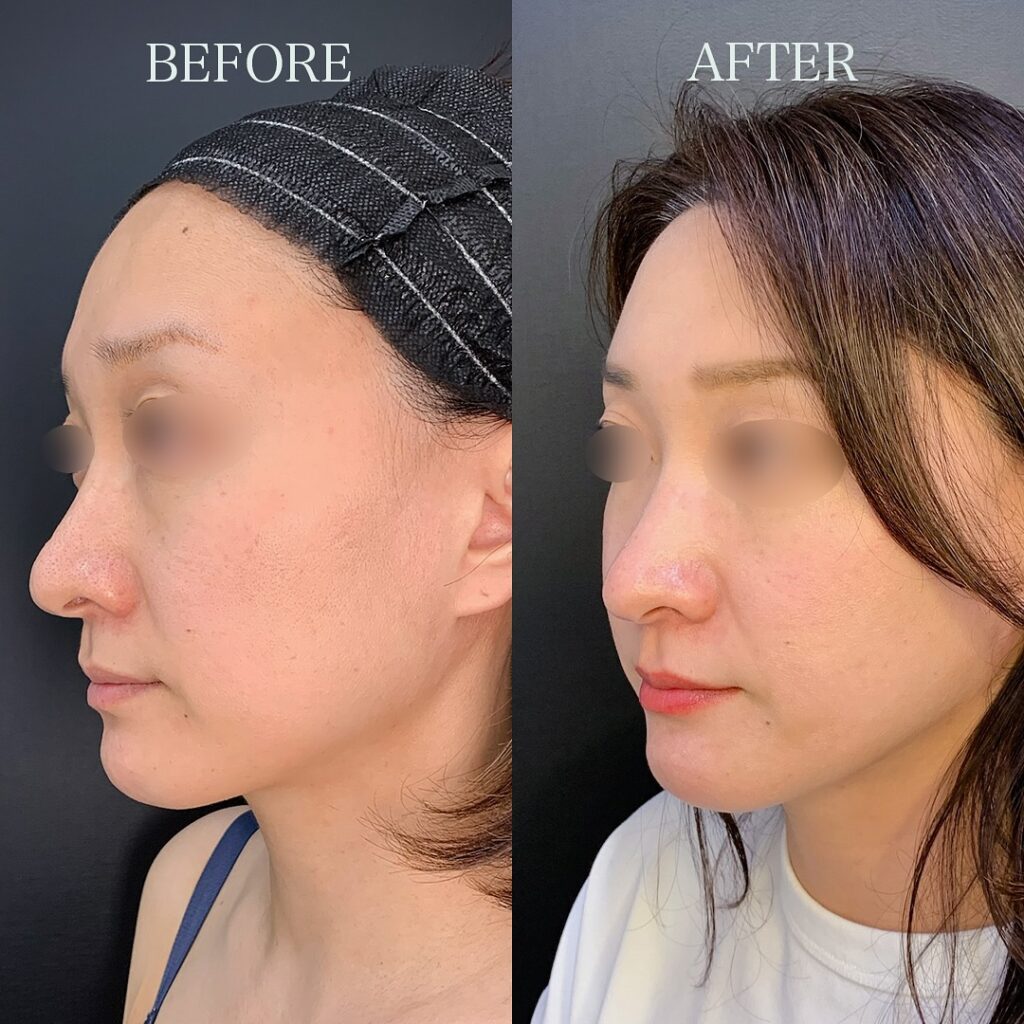 バッカルファットと頬、顎下の脂肪吸引とこめかみの脂肪注入と糸リフトの症例写真 (3)