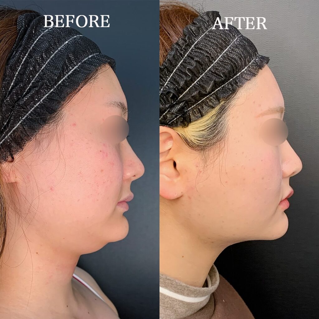 小顔の脂肪吸引と糸リフトの症例写真 (4)