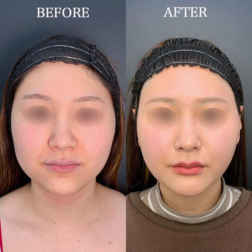 顎下の脂肪吸引と糸リフトの症例写真 (1)