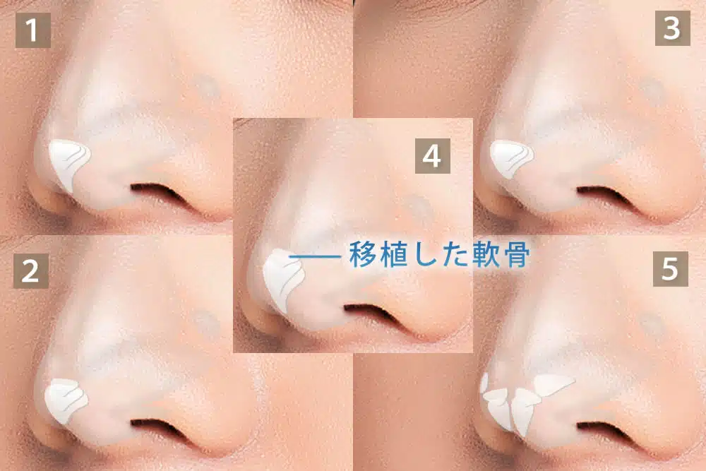 鼻尖軟骨移植の5つのパターン 横浜みなとみらい