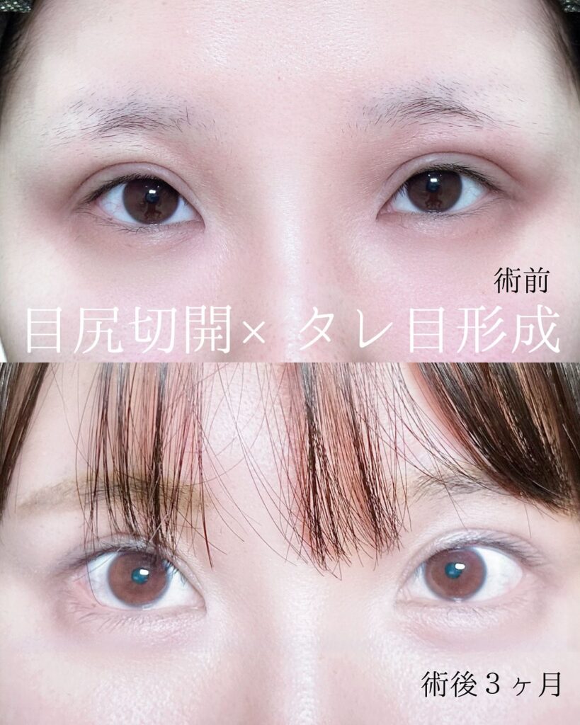 目尻切開とタレ目形成の症例写真 (2)