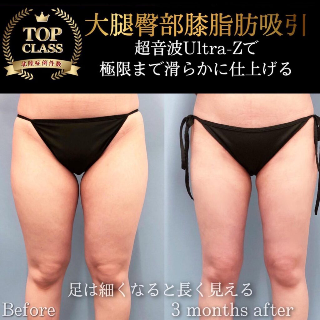 太ももの脂肪吸引の症例写真 (33)