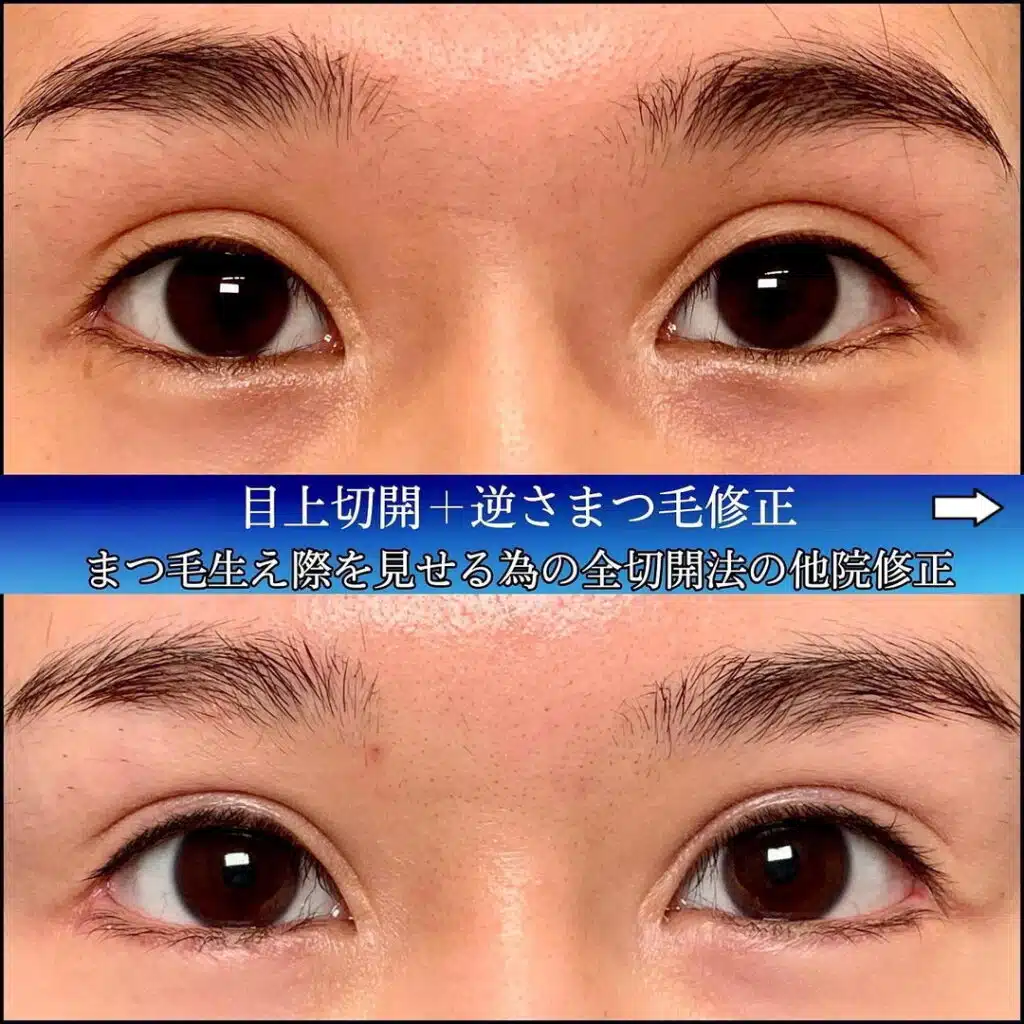 目上切開+逆さまつ毛修正　横浜みなとみらい