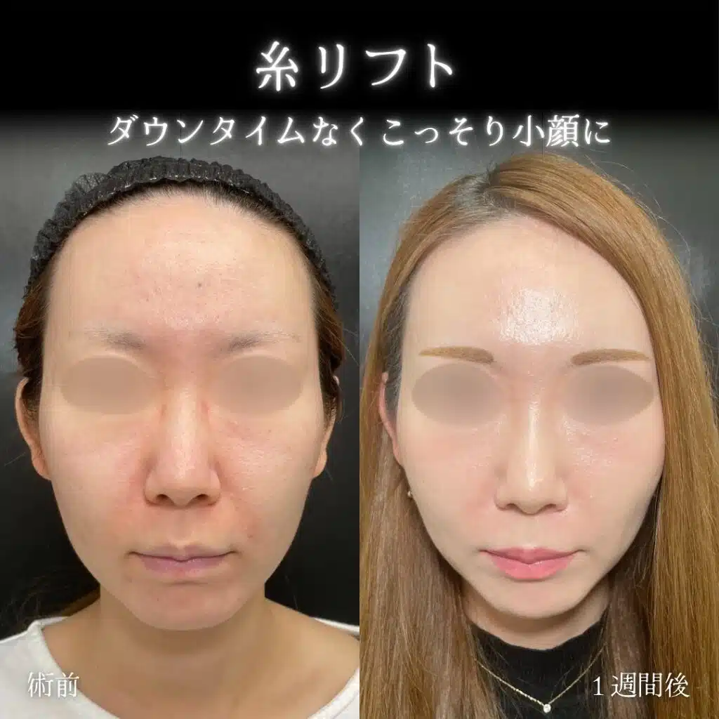 糸リフト　横浜みなとみらい
