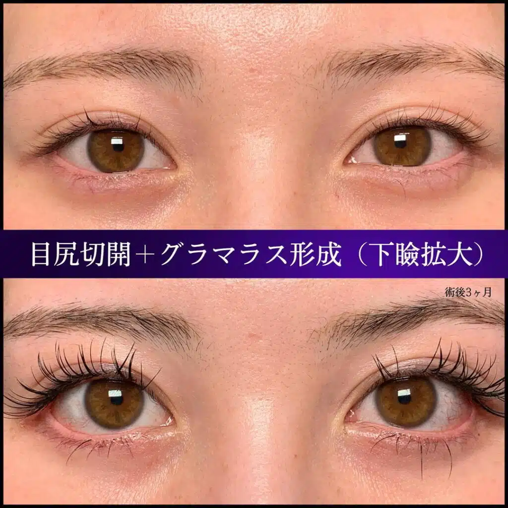 目尻切開+グラマラス形成(下瞼拡大) 横浜みなとみらい