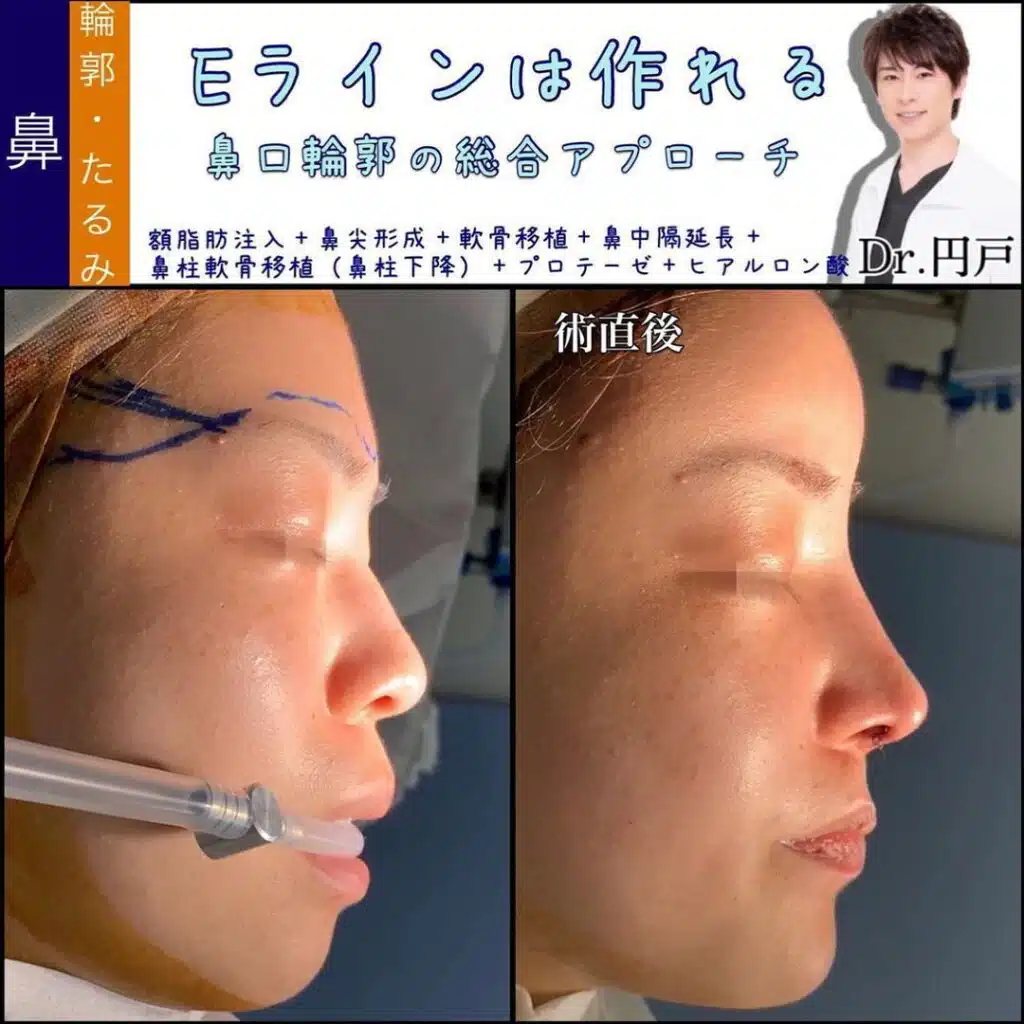 額脂肪注入+鼻尖形成+軟骨移植+鼻中隔延長+鼻柱軟骨移植(鼻柱下降)+プロテーゼ+ヒアルロン酸 横浜みなとみらい
