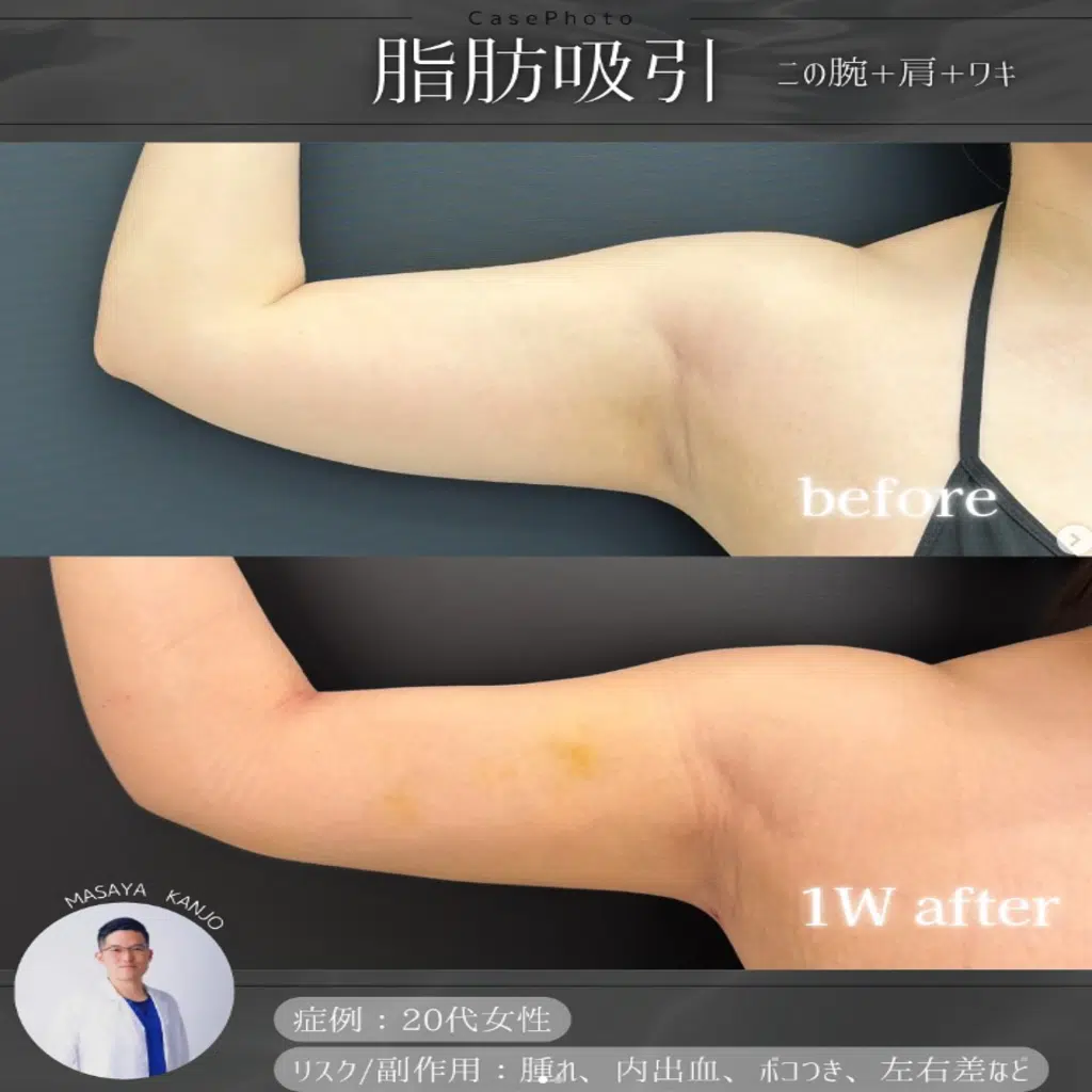 脂肪吸引 二の腕+肩+ワキ 横浜みなとみらい