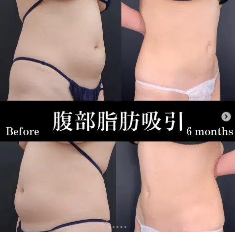 腹部脂肪吸引　横浜みなとみらい