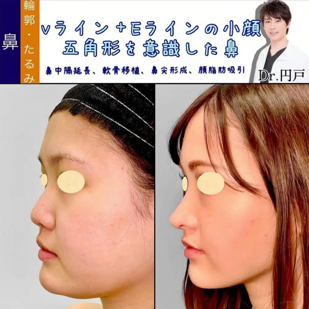 鼻中隔延長、軟骨移植、鼻尖形成、顔脂肪吸引　横浜みなとみらい