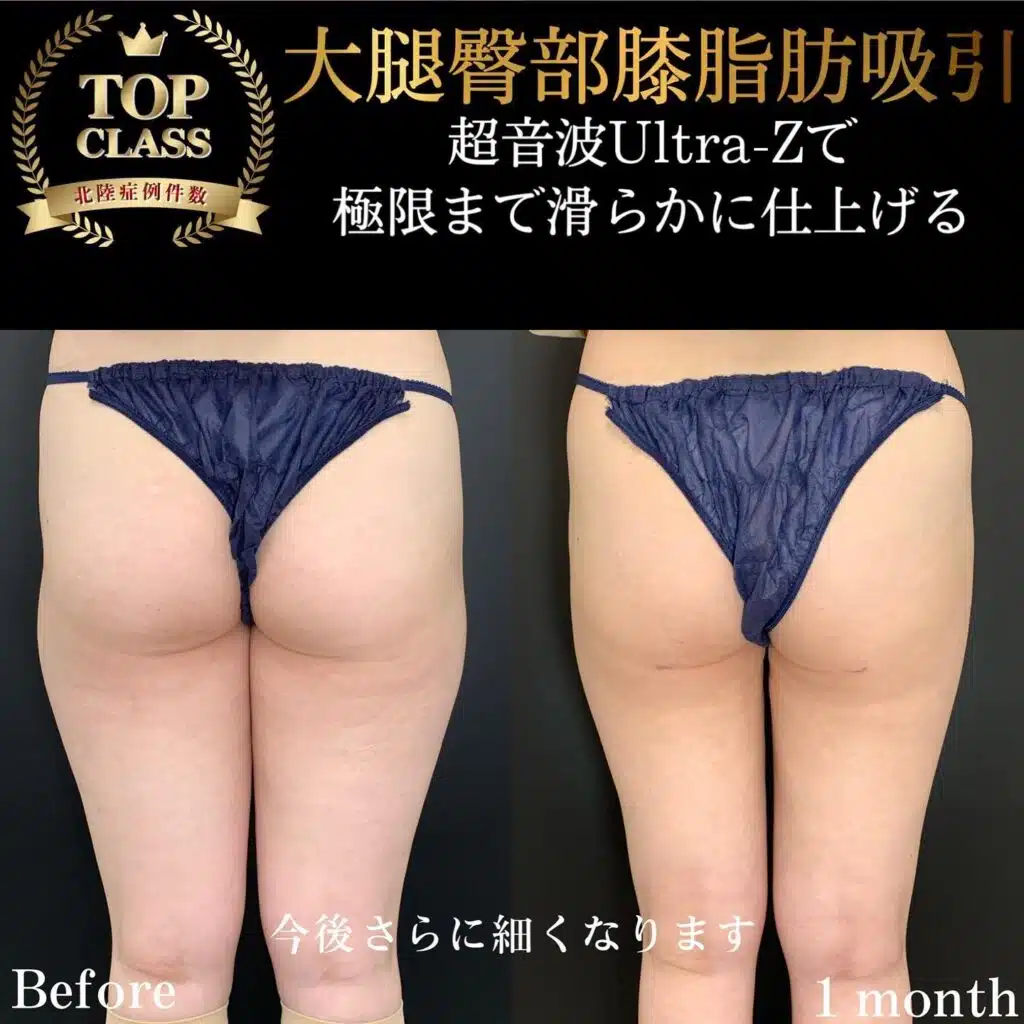大腿臀部膝脂肪吸引　横浜みなとみらい