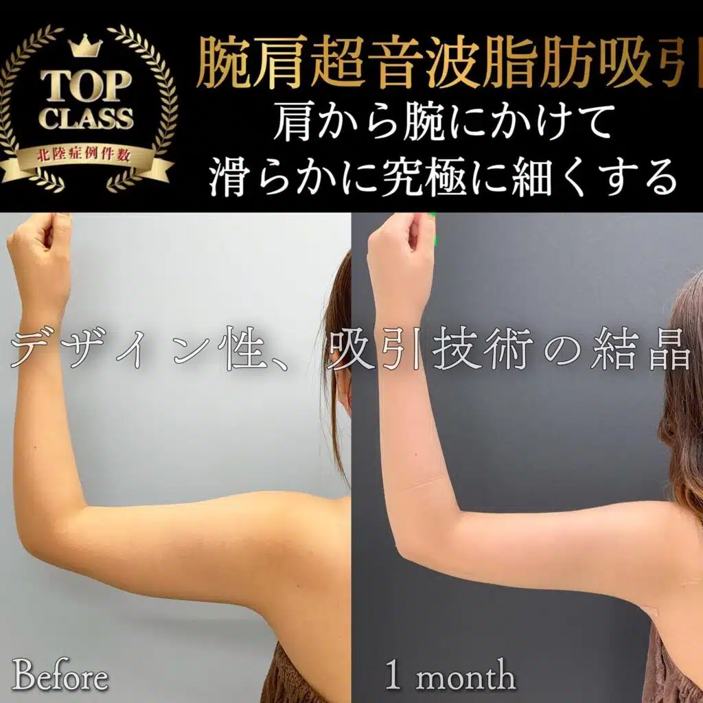腕肩超音波脂肪吸引 横浜みなとみらい