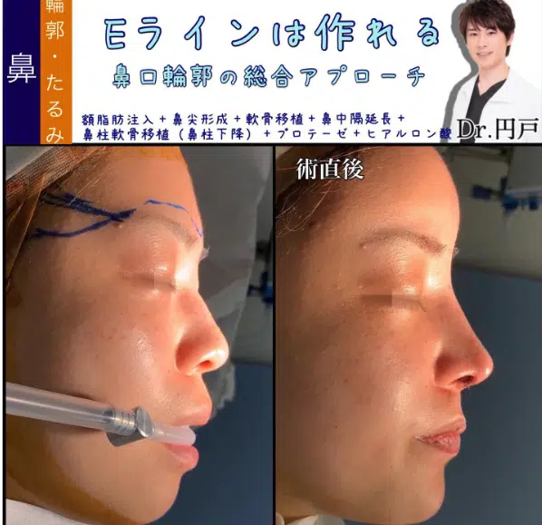 額脂肪注入+鼻尖形成+軟骨移植+鼻中隔延長+鼻柱軟骨移植（鼻柱下降）+プロテーゼ+ヒアルロン酸　横浜みなとみらい