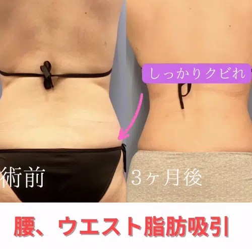 腰、ウエスト脂肪吸引　横浜みなとみらい