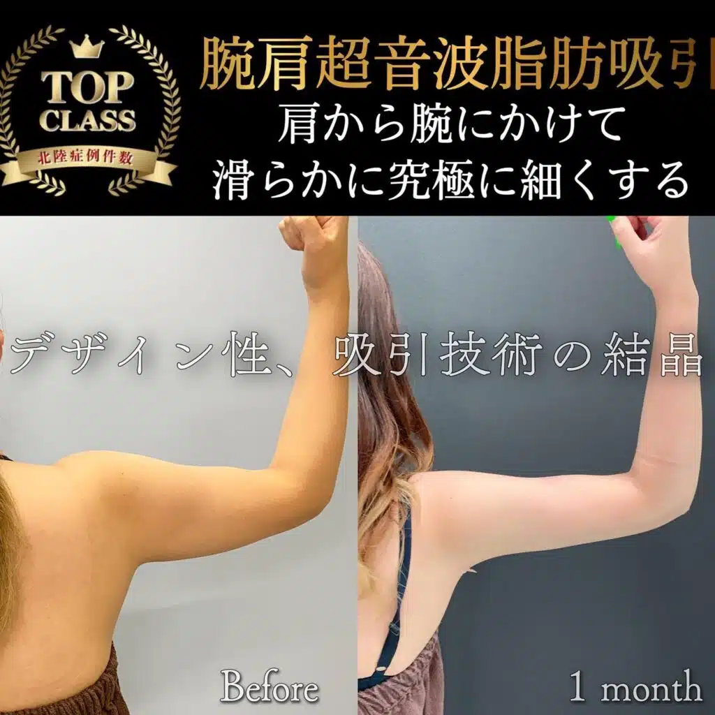 腕肩超音波脂肪吸引 横浜みなとみらい