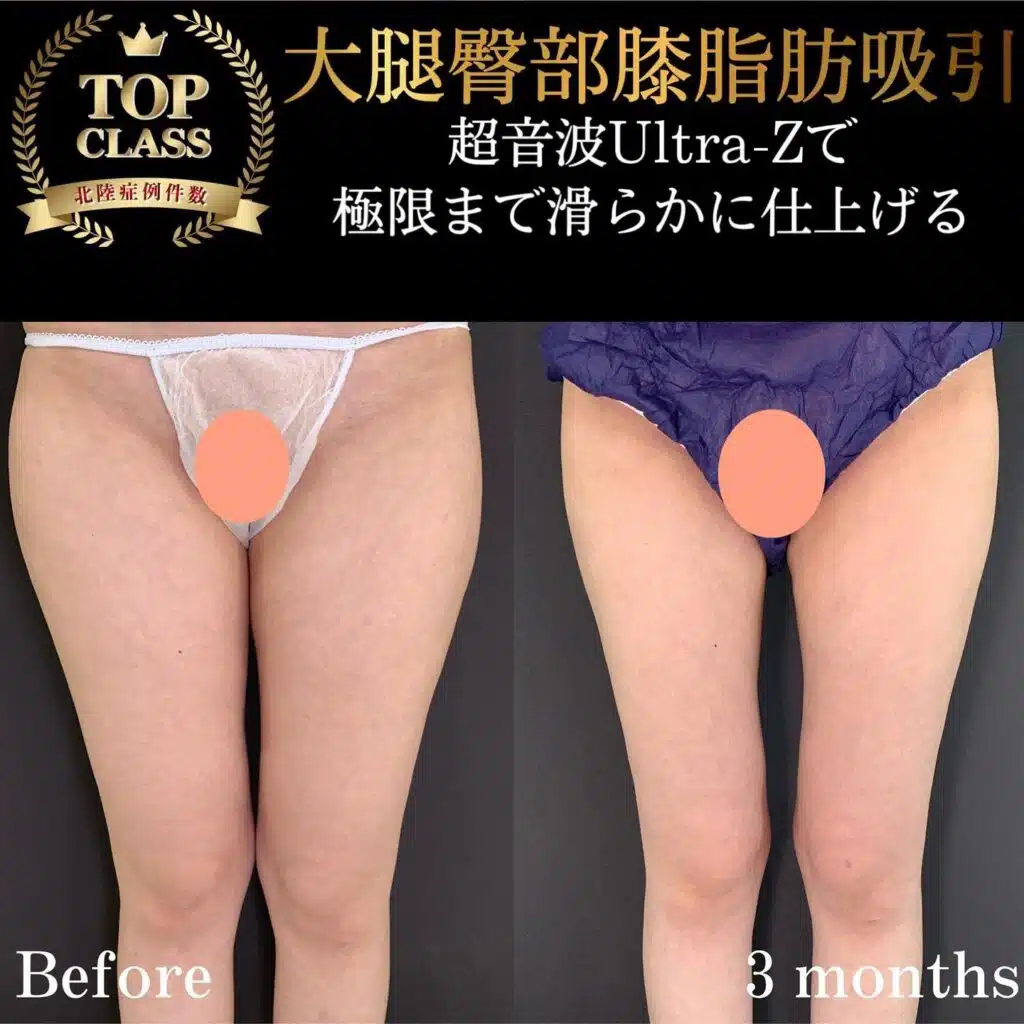 大腿臀部膝脂肪吸引　横浜みなとみらい