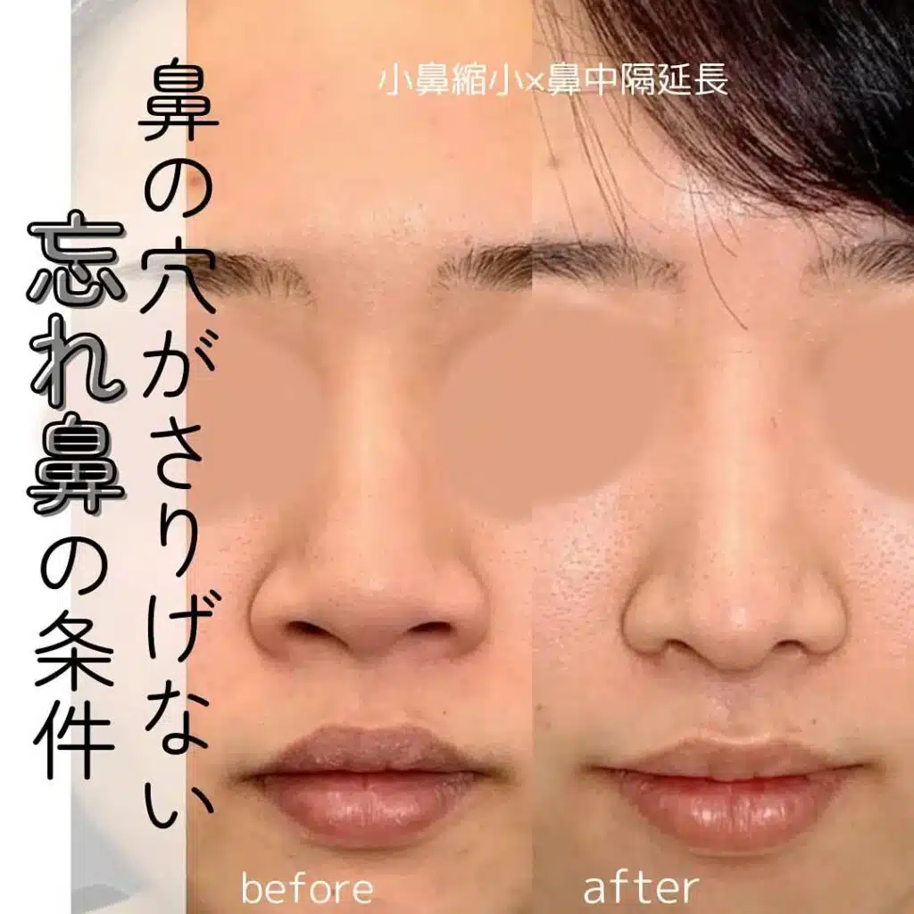 小鼻縮小×鼻中隔延長　横浜みなとみらい