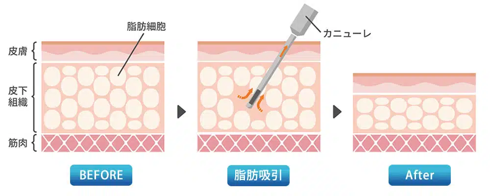 脂肪吸引　図解　横浜みなとみらい