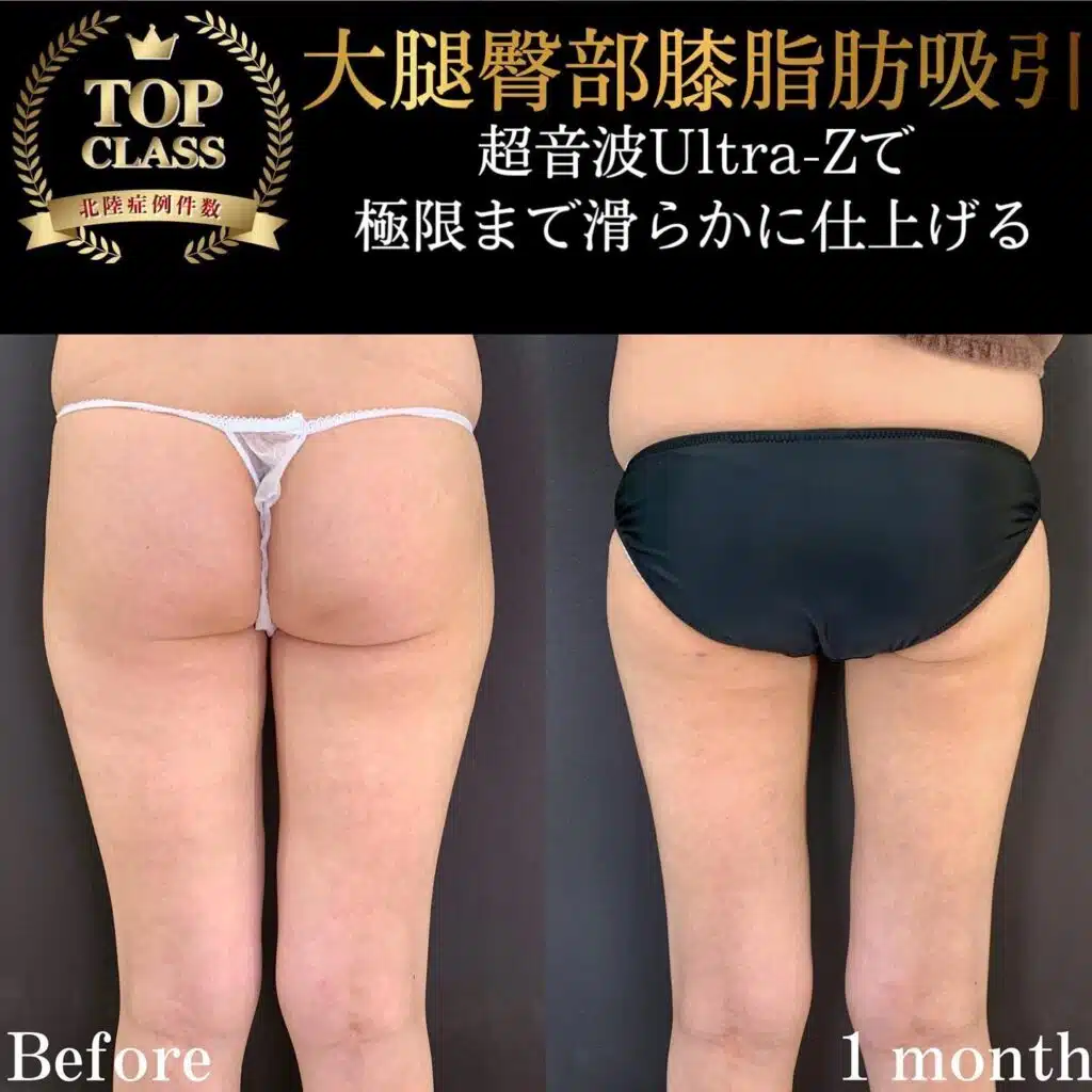 大腿臀部膝脂肪吸引　横浜みなとみらい