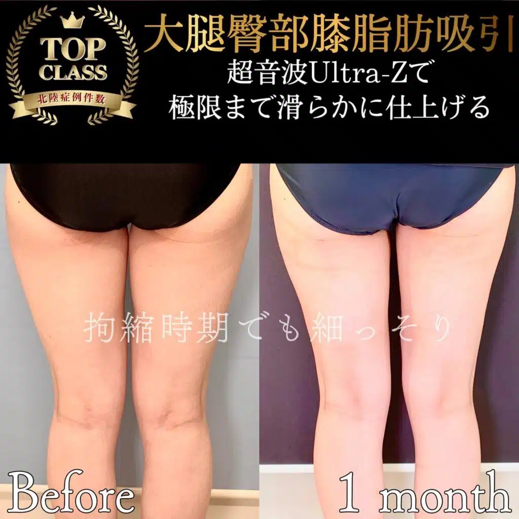 大腿臀部膝脂肪吸引　横浜みなとみらい