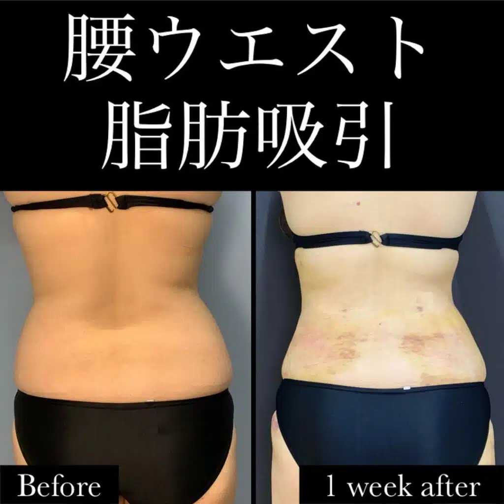 腰ウエスト脂肪吸引　横浜みなとみらい