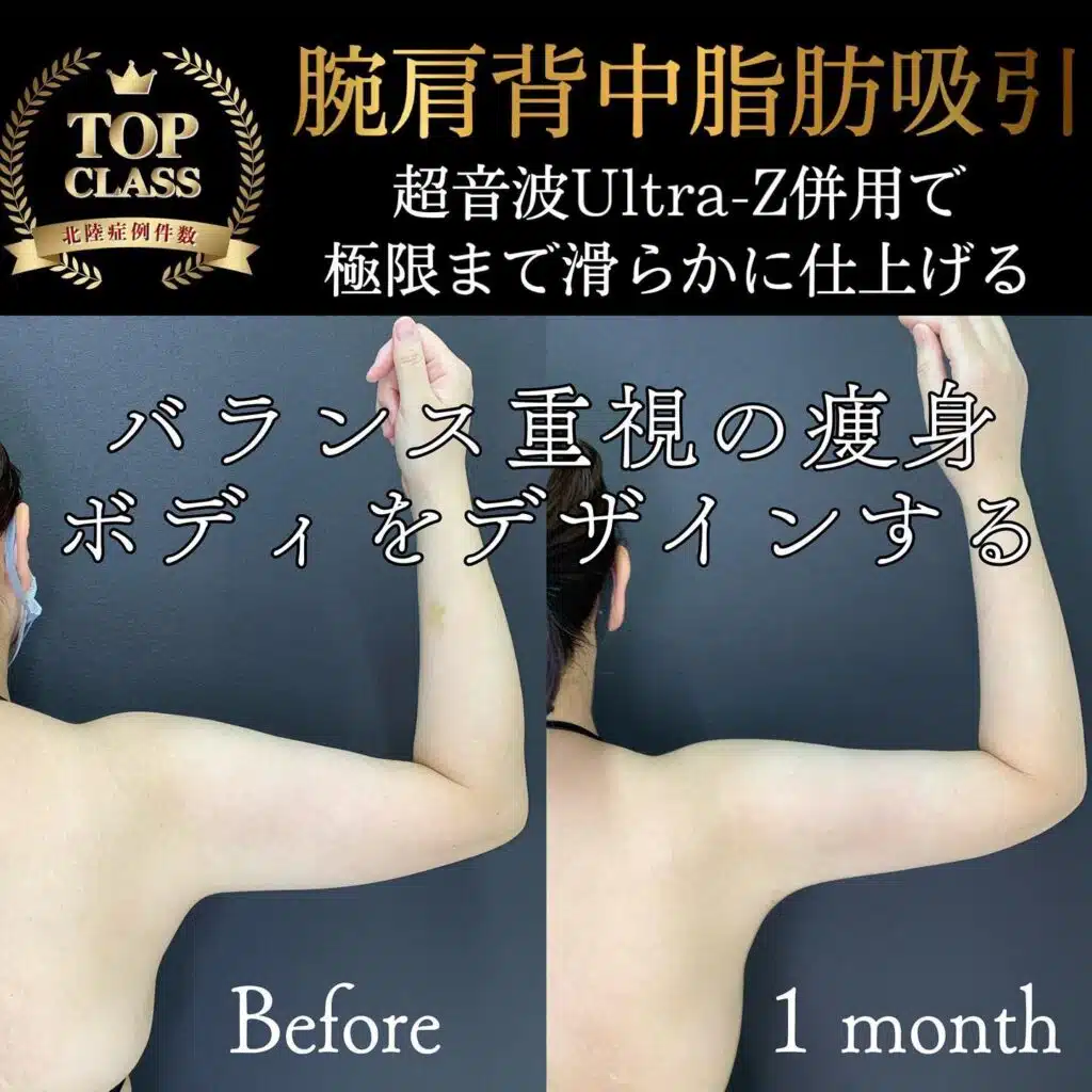 腕肩背中脂肪吸引 横浜みなとみらい