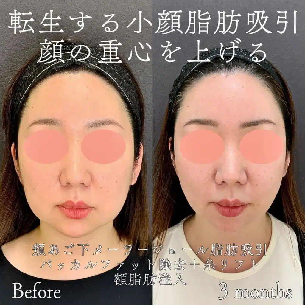 顔の脂肪吸引