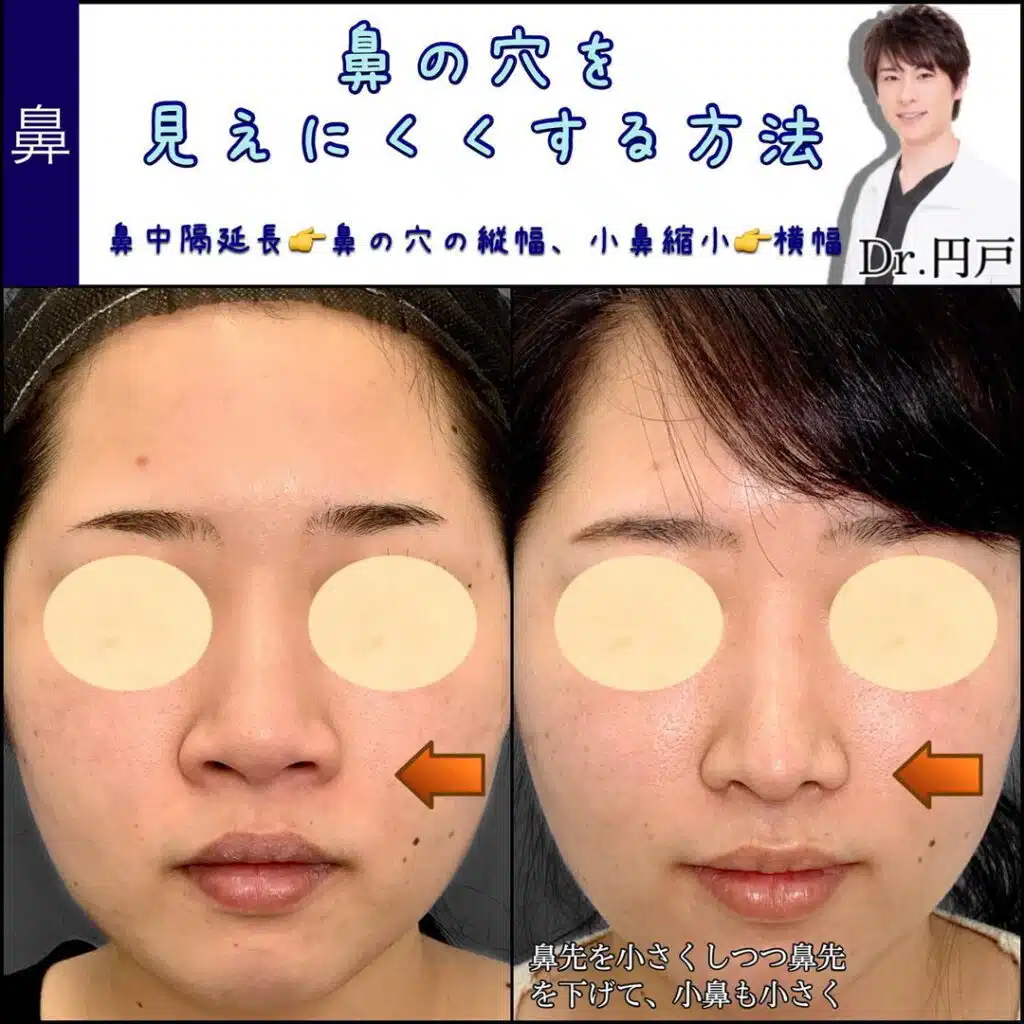 鼻中隔延長　小鼻縮小　横浜みなとみらい