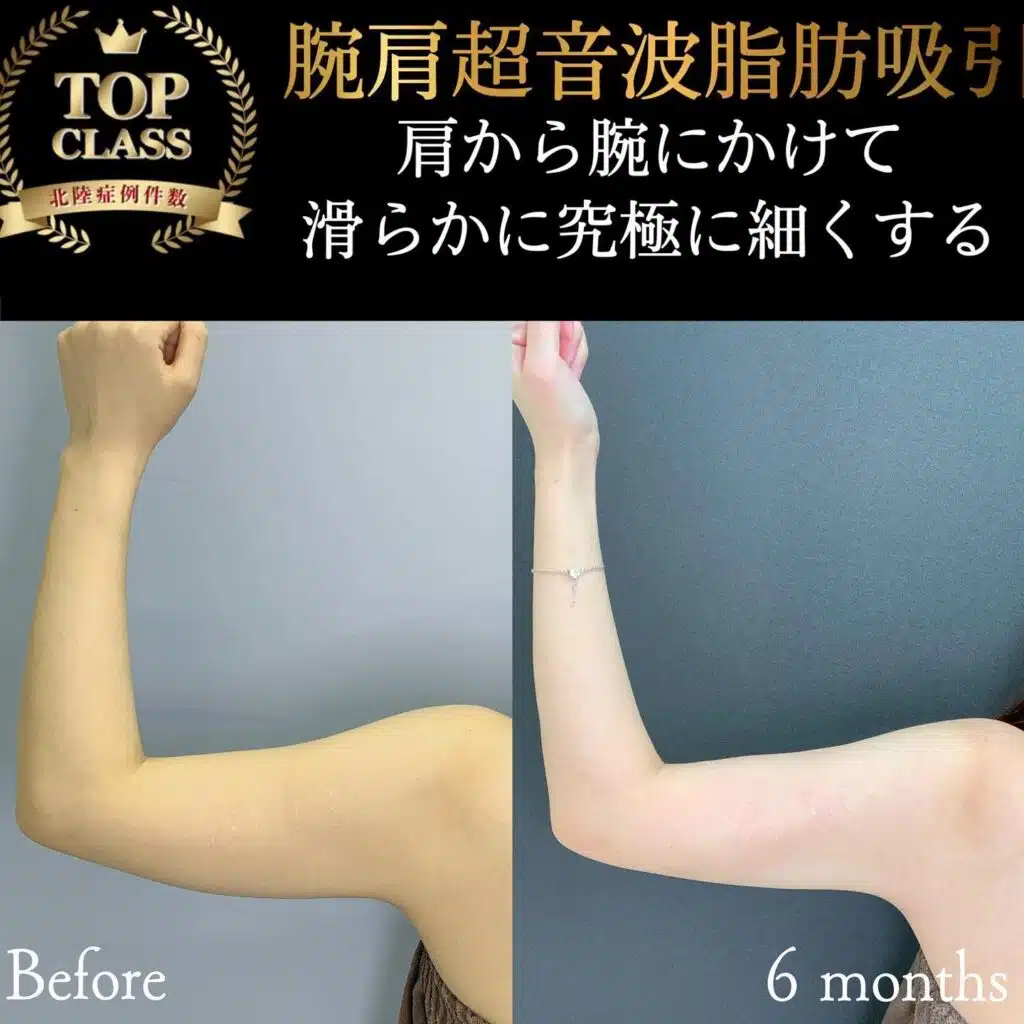 腕肩超音波脂肪吸引 横浜みなとみらい