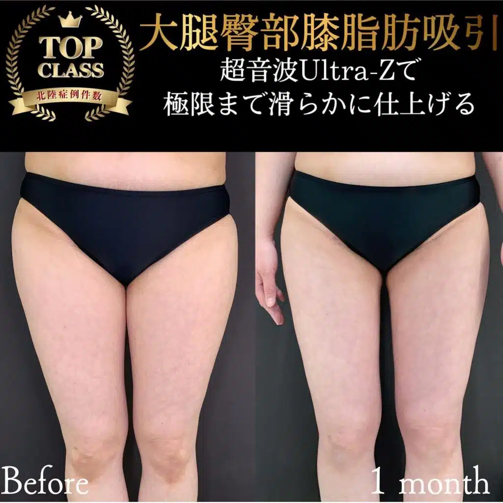 体の脂肪吸引